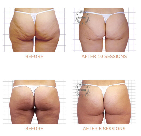Masaż próżniowy Icoone® Laser Med 2 - obrazek 3